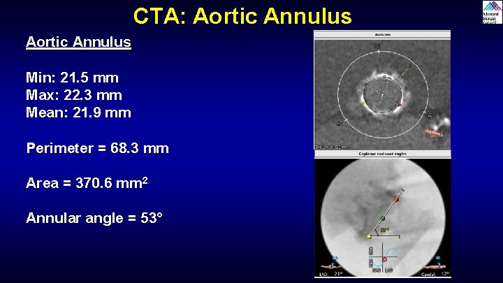 CTA: Aortic Annulus Min: 21. 5 mm Max: 22. 3 mm Mean: 21. 9 CTA: Aortic Annulus Min: 21. 5 mm Max: 22. 3 mm Mean: 21. 9