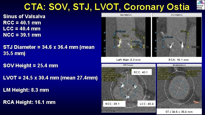 CTA: SOV, STJ, LVOT, Coronary Ostia Sinus of Valsalva RCC = 40. 1 mm CTA: SOV, STJ, LVOT, Coronary Ostia Sinus of Valsalva RCC = 40. 1 mm