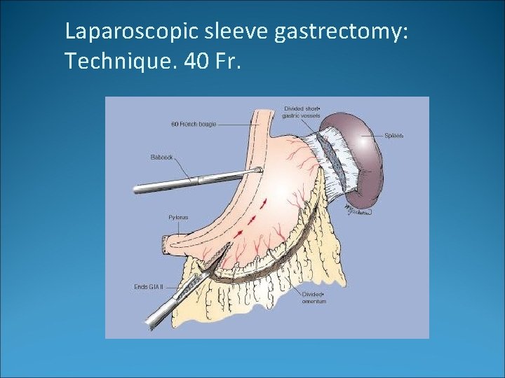 Laparoscopic sleeve gastrectomy: Technique. 40 Fr. 