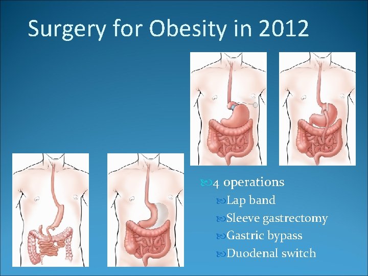 Surgery for Obesity in 2012 4 operations Lap band Sleeve gastrectomy Gastric bypass Duodenal