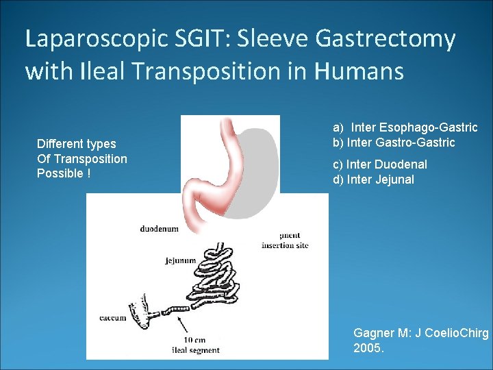 Laparoscopic SGIT: Sleeve Gastrectomy with Ileal Transposition in Humans Different types Of Transposition Possible