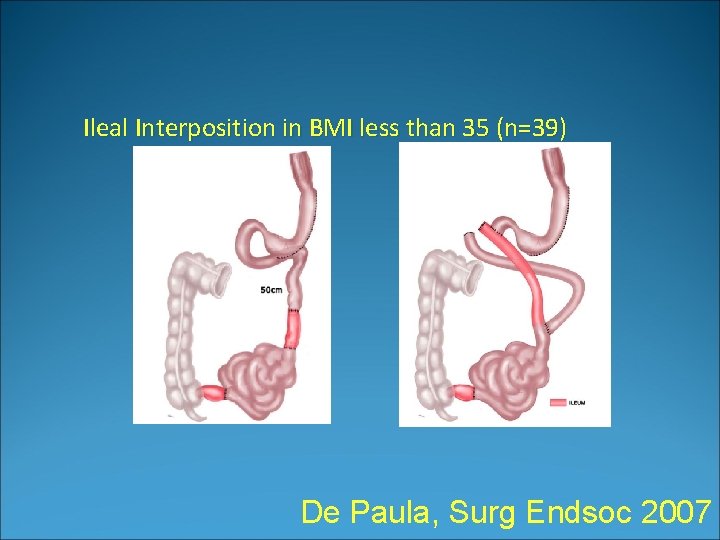 Ileal Interposition in BMI less than 35 (n=39) De Paula, Surg Endsoc 2007 