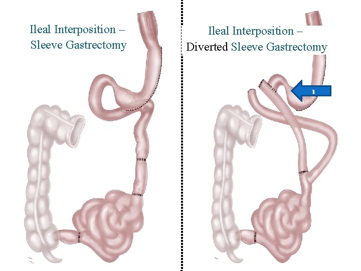 Ileal Interposition – Sleeve Gastrectomy Ileal Interposition – Diverted Sleeve Gastrectomy 1 