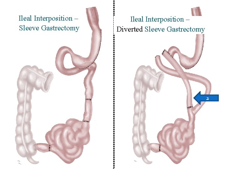 Ileal Interposition – Sleeve Gastrectomy Ileal Interposition – Diverted Sleeve Gastrectomy 2 