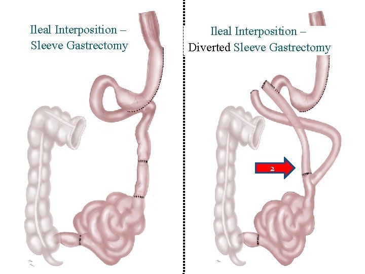 Ileal Interposition – Sleeve Gastrectomy Ileal Interposition – Diverted Sleeve Gastrectomy 2 
