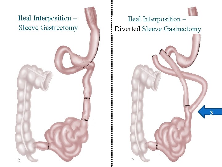 Ileal Interposition – Sleeve Gastrectomy Ileal Interposition – Diverted Sleeve Gastrectomy 3 