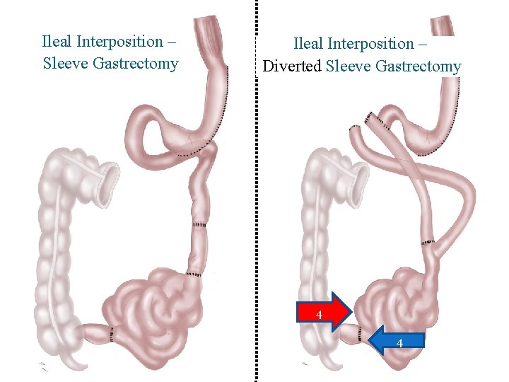 Ileal Interposition – Sleeve Gastrectomy Ileal Interposition – Diverted Sleeve Gastrectomy 4 4 