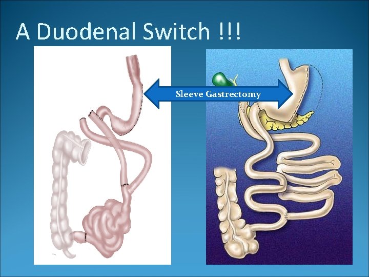 A Duodenal Switch !!! Sleeve Gastrectomy 