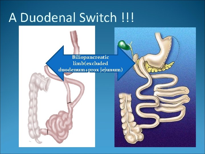 A Duodenal Switch !!! Biliopancreatic limb(excluded duodenum+prox jejunum) 