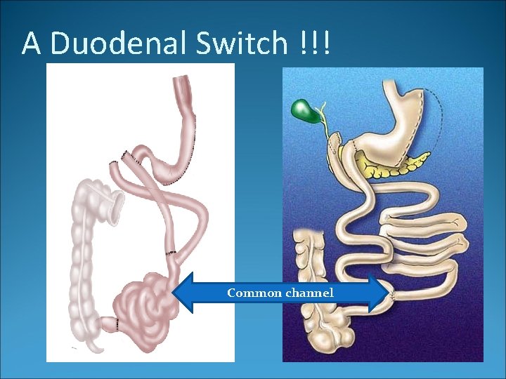 A Duodenal Switch !!! Common channel 
