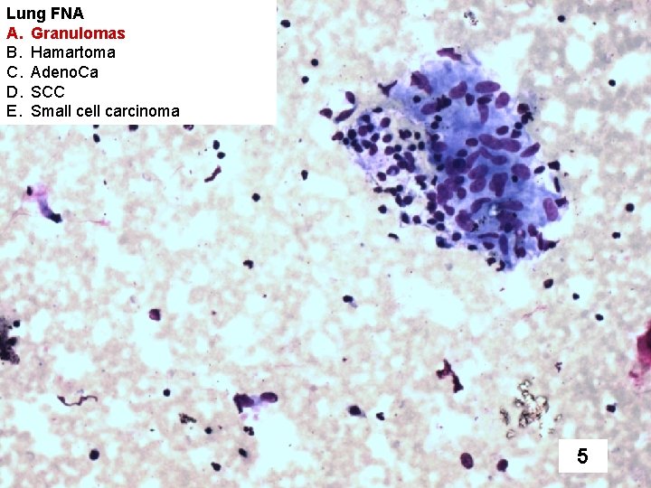 Lung FNA A. Granulomas B. Hamartoma C. Adeno. Ca D. SCC E. Small cell