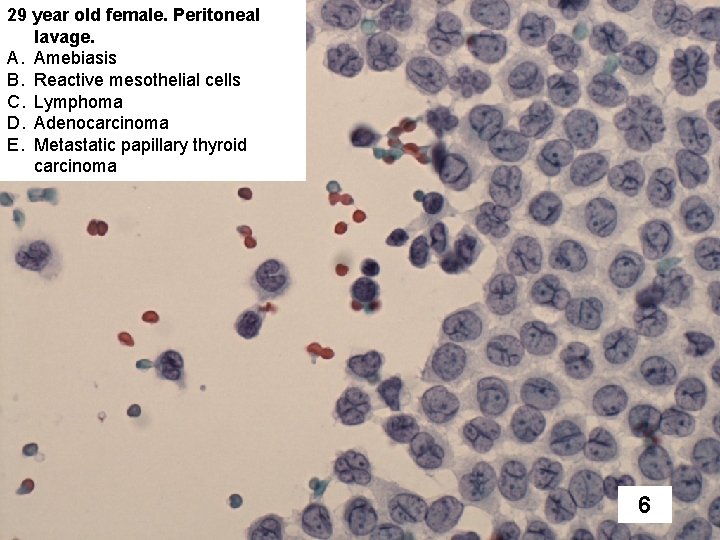 29 year old female. Peritoneal lavage. A. Amebiasis B. Reactive mesothelial cells C. Lymphoma