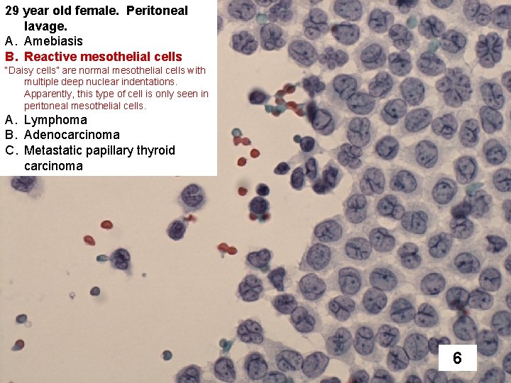 29 year old female. Peritoneal lavage. A. Amebiasis B. Reactive mesothelial cells “Daisy cells”