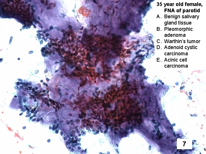 35 year old female, FNA of parotid A. Benign salivary gland tissue B. Pleomorphic