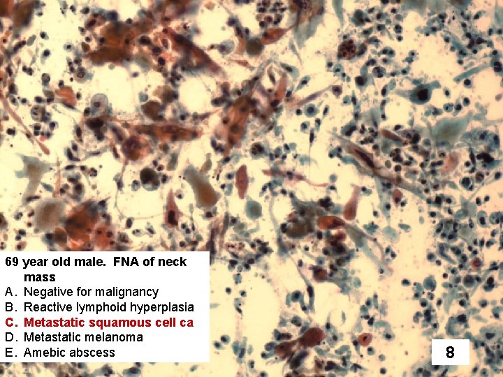 69 year old male. FNA of neck mass A. Negative for malignancy B. Reactive