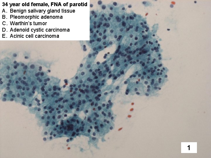 34 year old female, FNA of parotid A. Benign salivary gland tissue B. Pleomorphic
