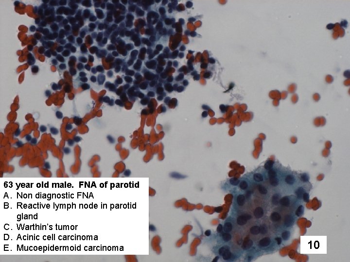 63 year old male. FNA of parotid A. Non diagnostic FNA B. Reactive lymph