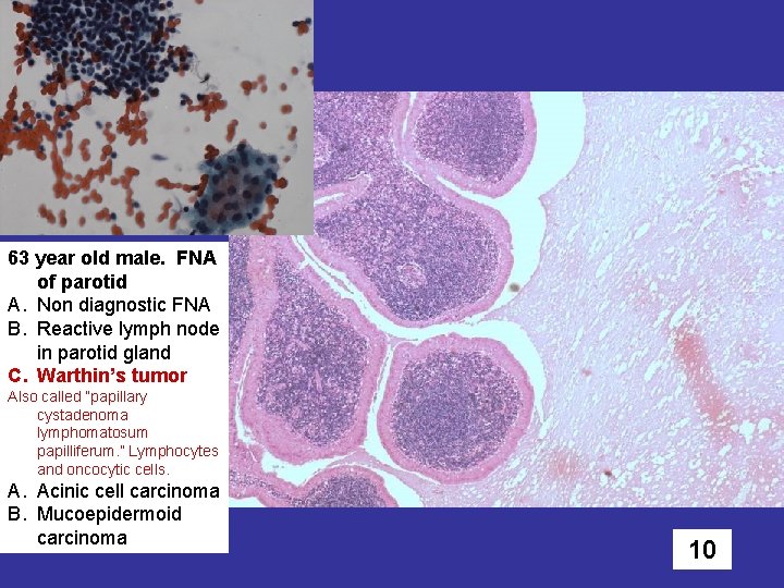 63 year old male. FNA of parotid A. Non diagnostic FNA B. Reactive lymph