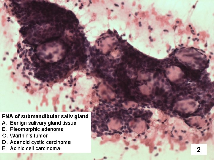 FNA of submandibular saliv gland A. Benign salivary gland tissue B. Pleomorphic adenoma C.