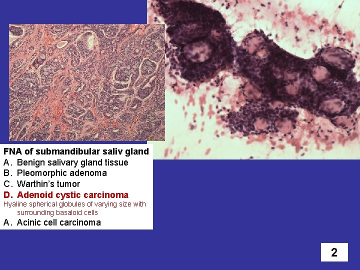 FNA of submandibular saliv gland A. Benign salivary gland tissue B. Pleomorphic adenoma C.