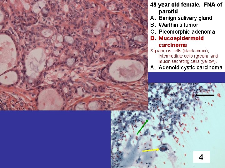 49 year old female. FNA of parotid A. Benign salivary gland B. Warthin’s tumor