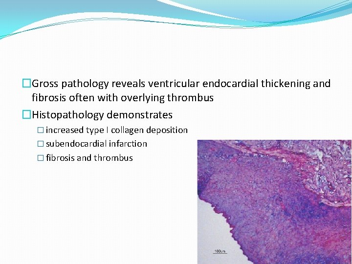 �Gross pathology reveals ventricular endocardial thickening and fibrosis often with overlying thrombus �Histopathology demonstrates