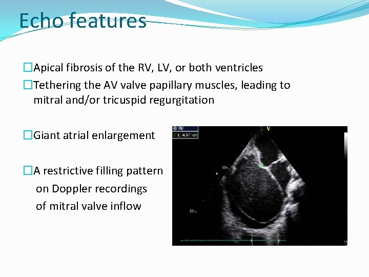 Echo features �Apical fibrosis of the RV, LV, or both ventricles �Tethering the AV