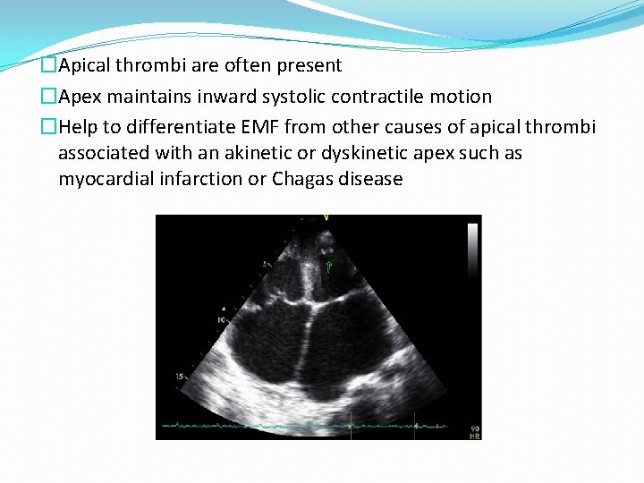 �Apical thrombi are often present �Apex maintains inward systolic contractile motion �Help to differentiate