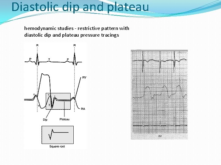 Diastolic dip and plateau hemodynamic studies - restrictive pattern with diastolic dip and plateau