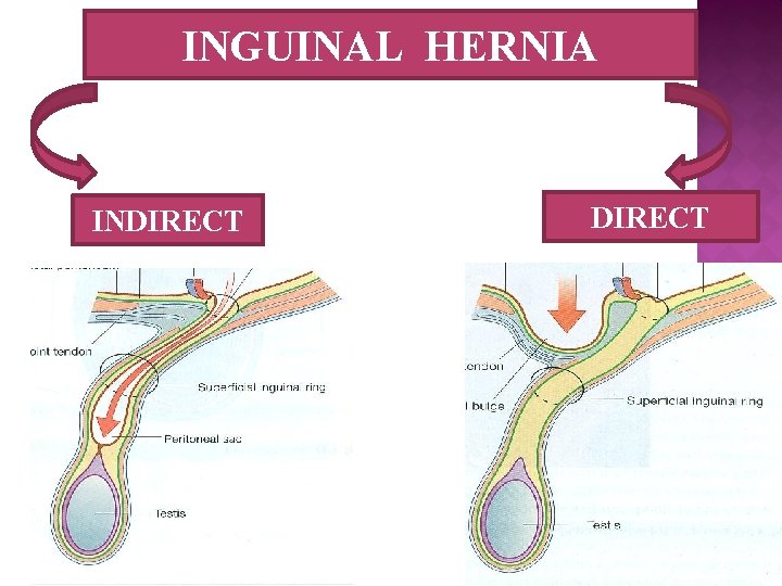 INGUINAL HERNIA INDIRECT 