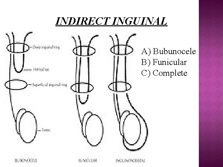 INDIRECT INGUINAL A) Bubunocele B) Funicular C) Complete 