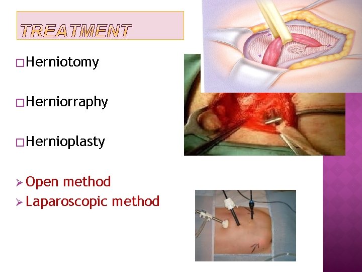 � Herniotomy � Herniorraphy � Hernioplasty Ø Open method Ø Laparoscopic method 