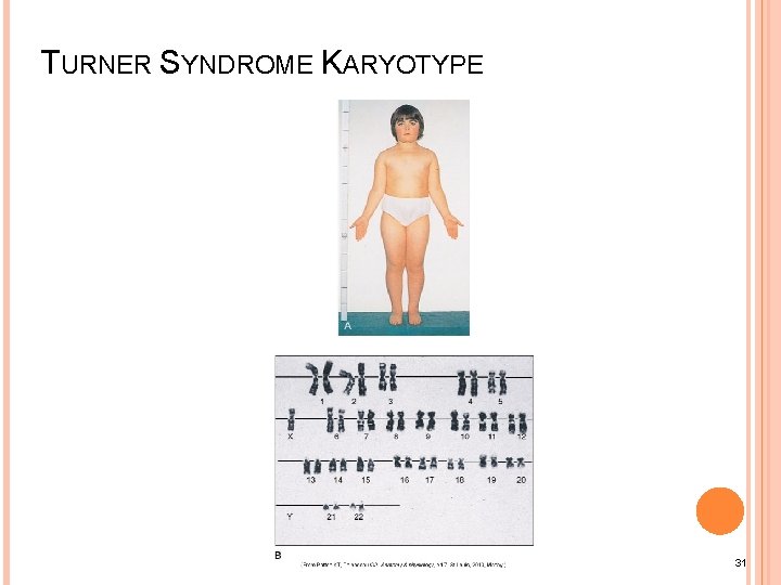 TURNER SYNDROME KARYOTYPE 31 