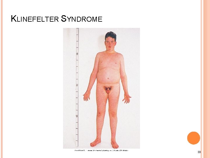 KLINEFELTER SYNDROME 33 