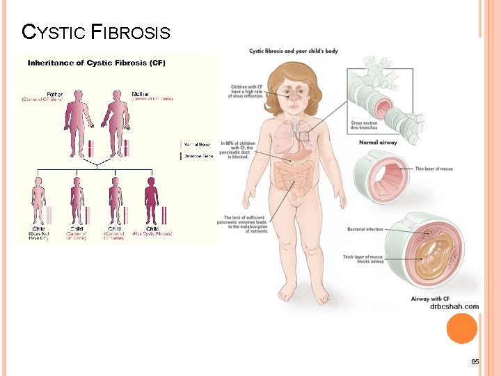 CYSTIC FIBROSIS 65 