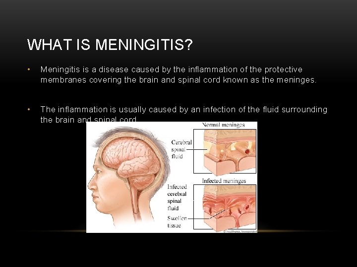 WHAT IS MENINGITIS? • Meningitis is a disease caused by the inflammation of the
