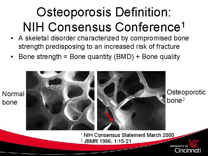 Osteoporosis Definition: NIH Consensus Conference 1 • A skeletal disorder characterized by compromised bone