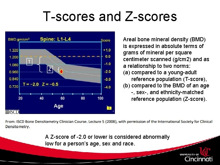 T-scores and Z-scores Areal bone mineral density (BMD) is expressed in absolute terms of