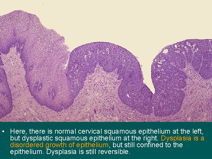 • Here, there is normal cervical squamous epithelium at the left, but dysplastic