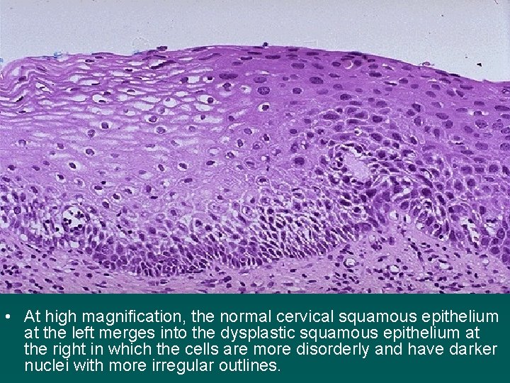  • At high magnification, the normal cervical squamous epithelium at the left merges