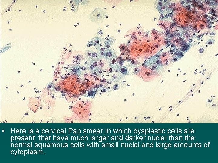  • Here is a cervical Pap smear in which dysplastic cells are present