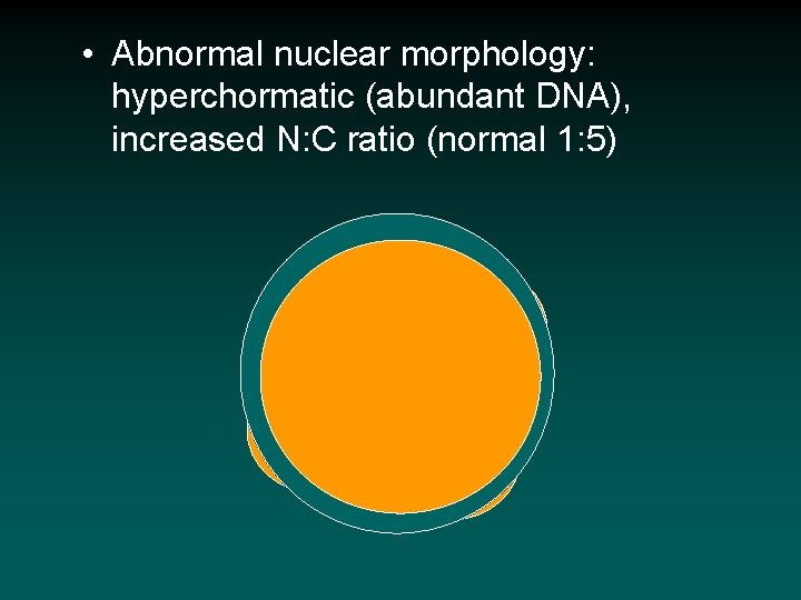  • Abnormal nuclear morphology: hyperchormatic (abundant DNA), increased N: C ratio (normal 1: