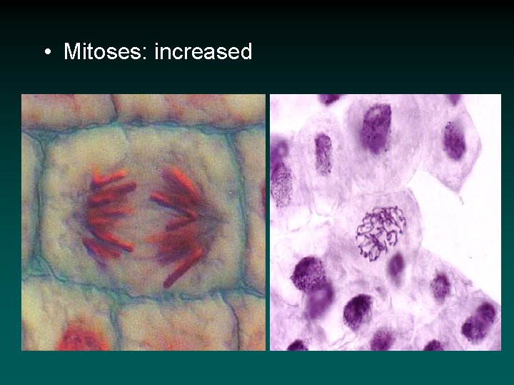  • Mitoses: increased 