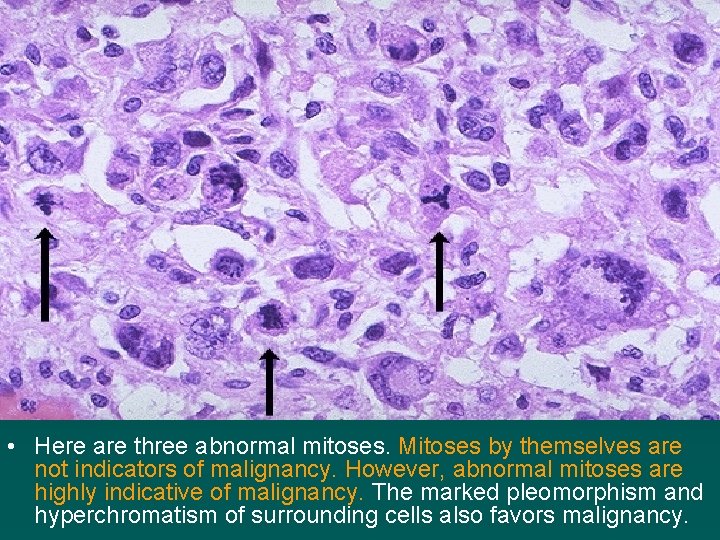  • Here are three abnormal mitoses. Mitoses by themselves are not indicators of