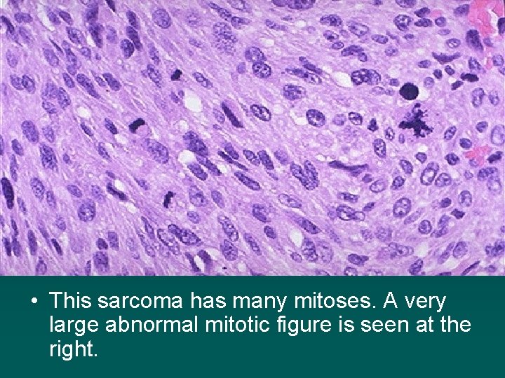  • This sarcoma has many mitoses. A very large abnormal mitotic figure is