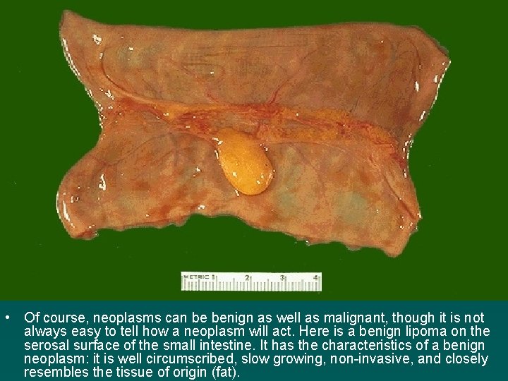  • Of course, neoplasms can be benign as well as malignant, though it