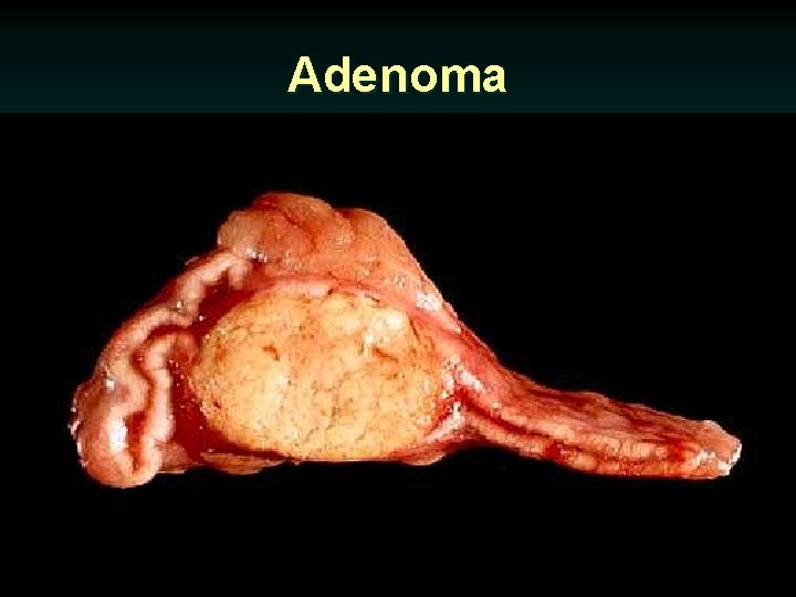 Adenoma 