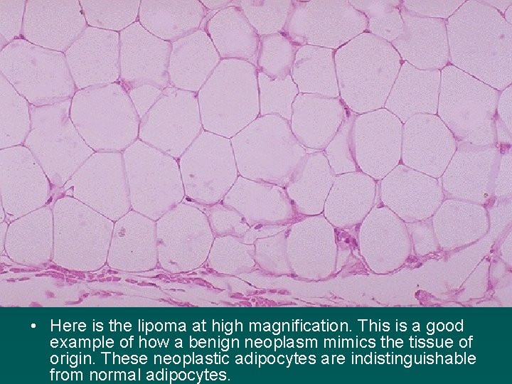  • Here is the lipoma at high magnification. This is a good example