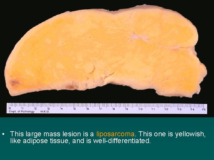  • This large mass lesion is a liposarcoma. This one is yellowish, like