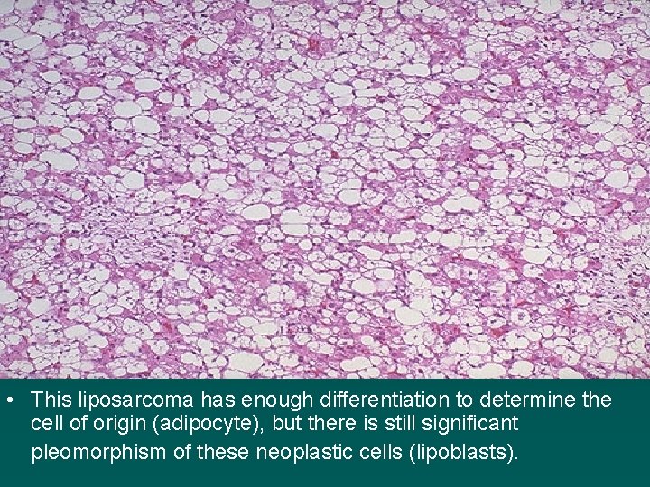  • This liposarcoma has enough differentiation to determine the cell of origin (adipocyte),